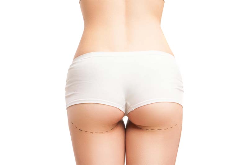 Implantes de relleno