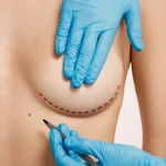 Aumento de pecho seguro: consejos, cuidados y recomendaciones profesionales mujer-marcada-para-cirugia-estetica_resize