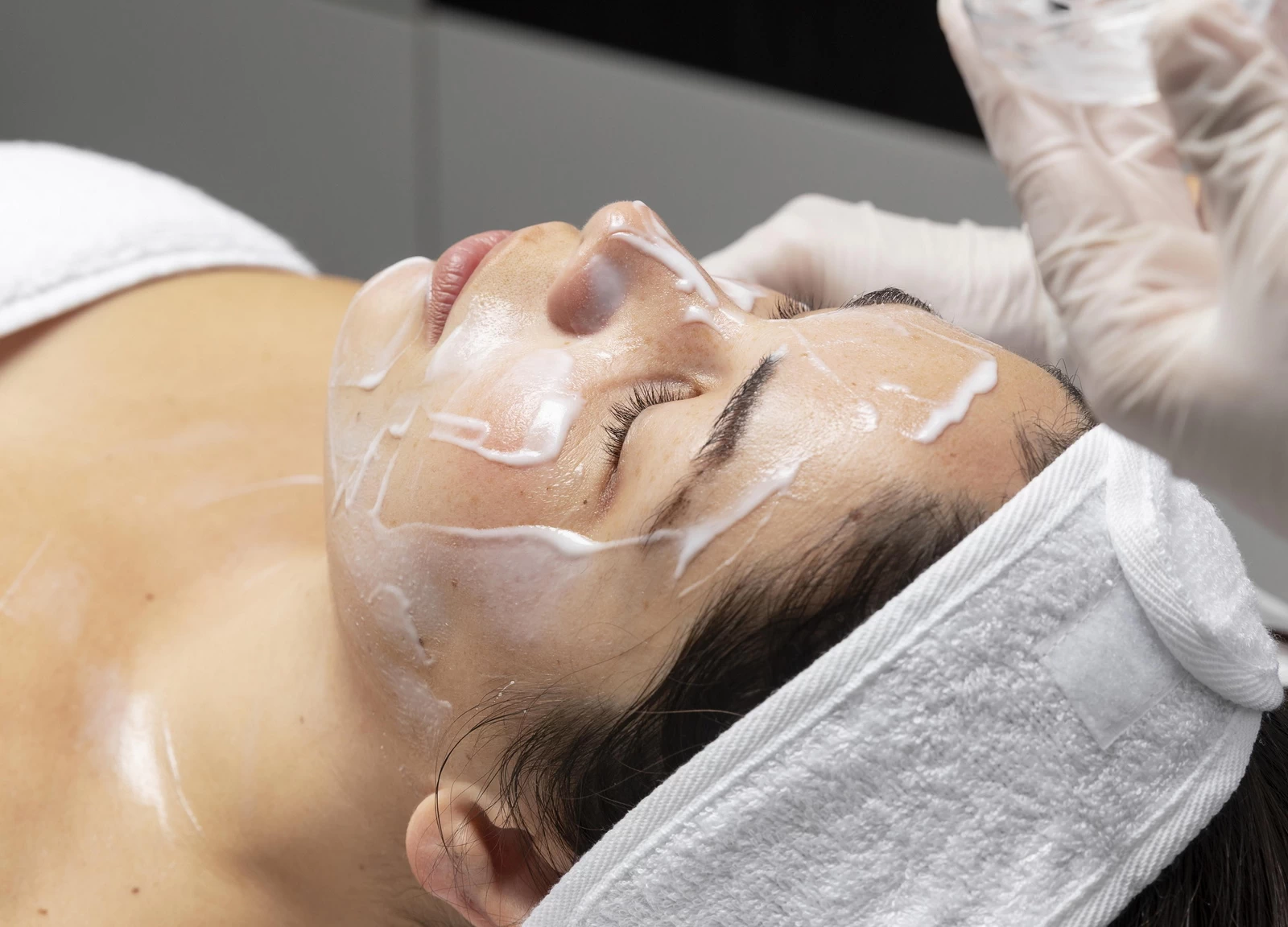 Peeling Químico en Bilbao: ¿Cuándo es el Mejor Momento para Hacerlo?