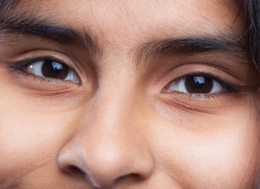 Los 4 tipos de ojeras: causas y tratamientos en medicina estética en Bilbao