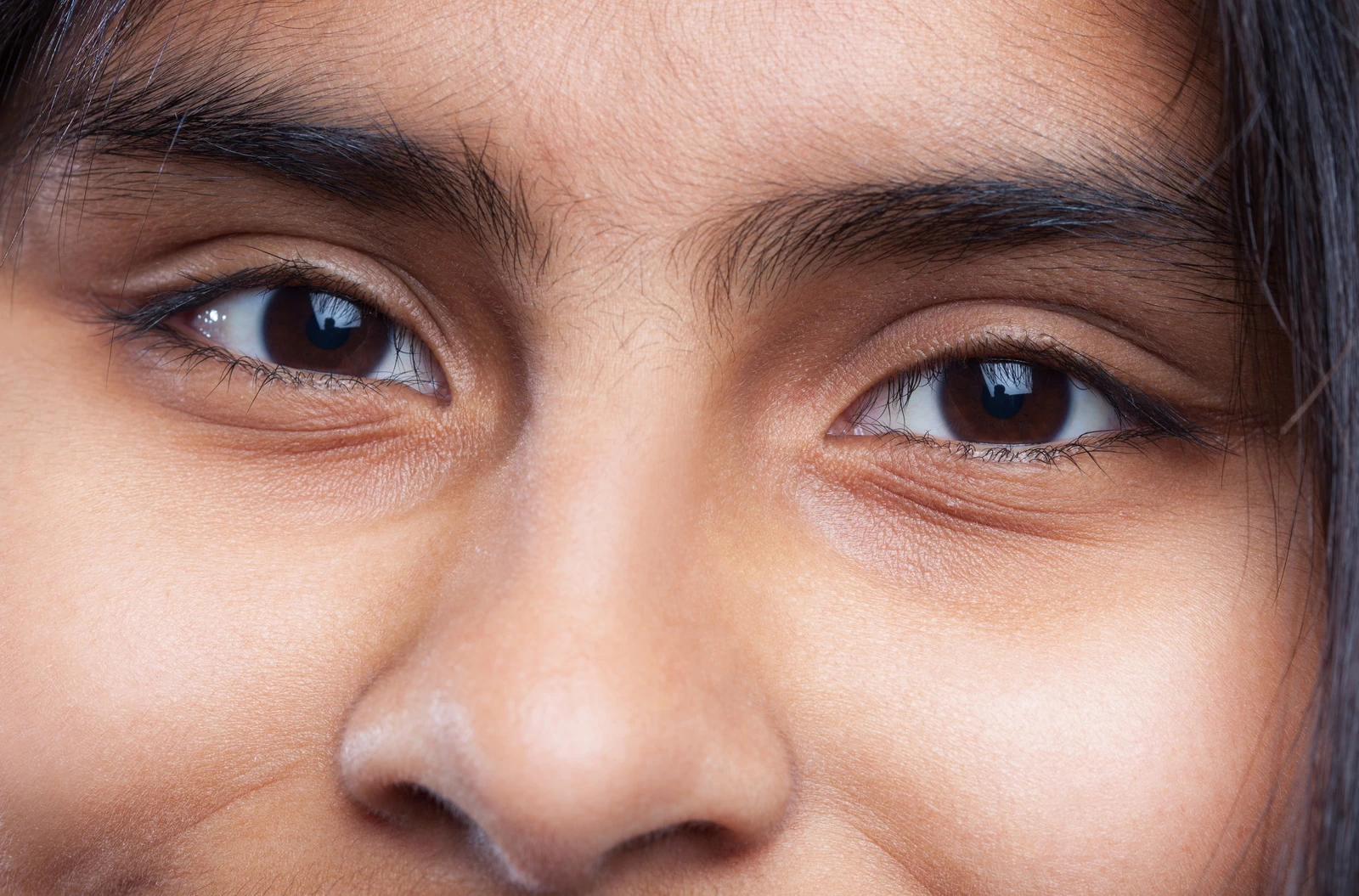 Los 4 tipos de ojeras: causas y tratamientos en medicina estética en Bilbao